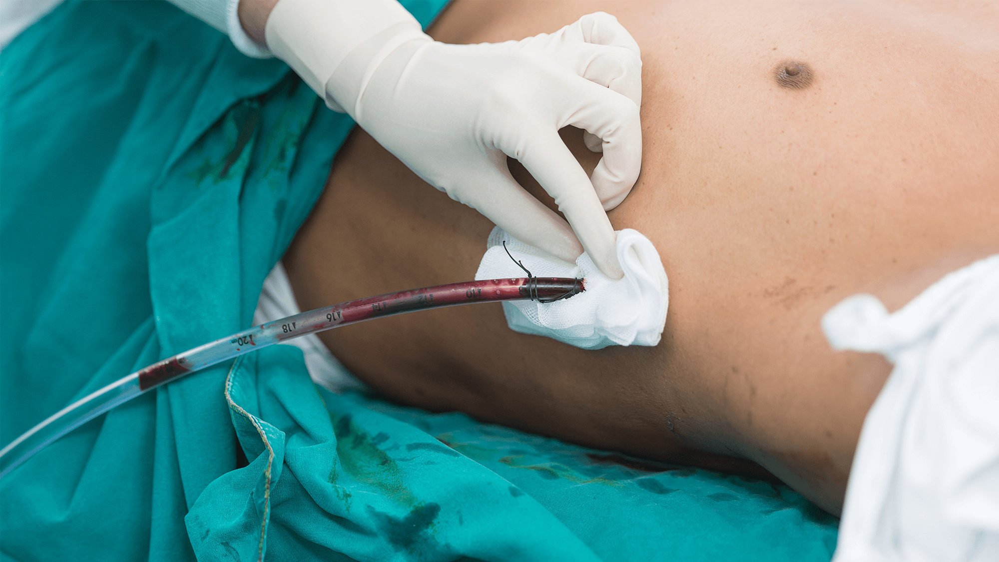 chest tube site