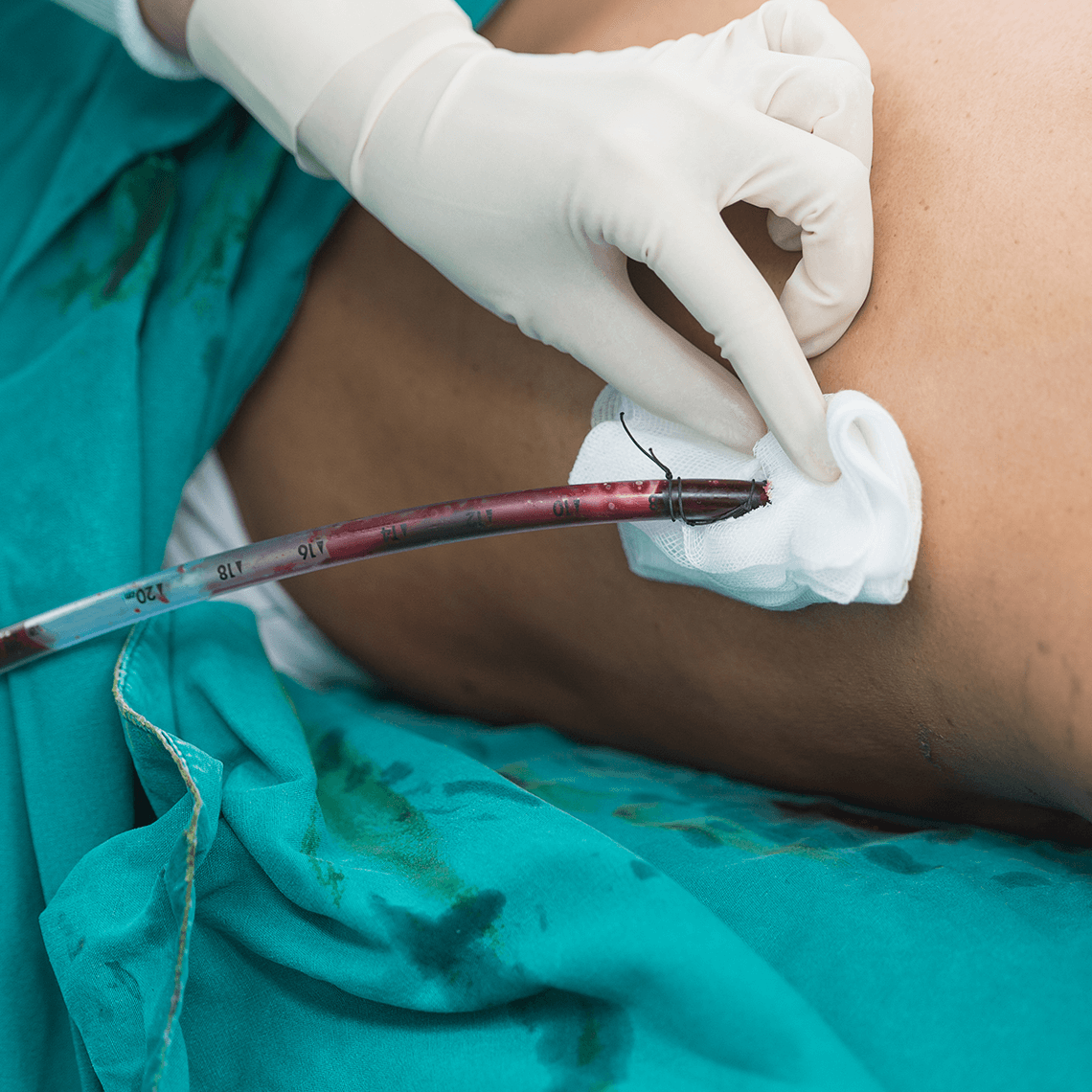 casestudy2024chesttube 1x1